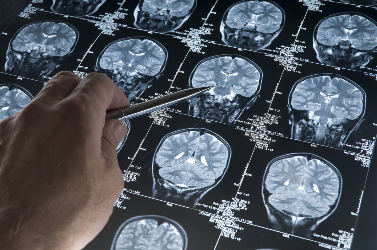 dip_sci's tweet photo. Our 🧠 have a multitude of cells called #glia that support #neurons. In "#Alzheimer’s Disease: The Fault in Our Astrocytes" Dr. @robinsawaya focuses on the role a particular kind of glia - #astrocytes - play in the development of Alzheimer's Disease. 
➡ https://t.co/wXSZ3LbBem https://t.co/pyDBWex1jY