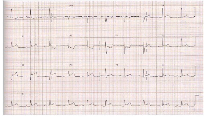 AcemaMza's tweet photo. El paciente se mantiene asintomático durante la primera hora de ingreso en el servicio de urgencia .De forma repentina manifiesta opresión centrotorácica, acompañada de malestar general .Se realiza un Electrocardiograma de 12 derivaciones ¿ Cual es el diagnostico del paciente? https://t.co/1It0dBCJuc