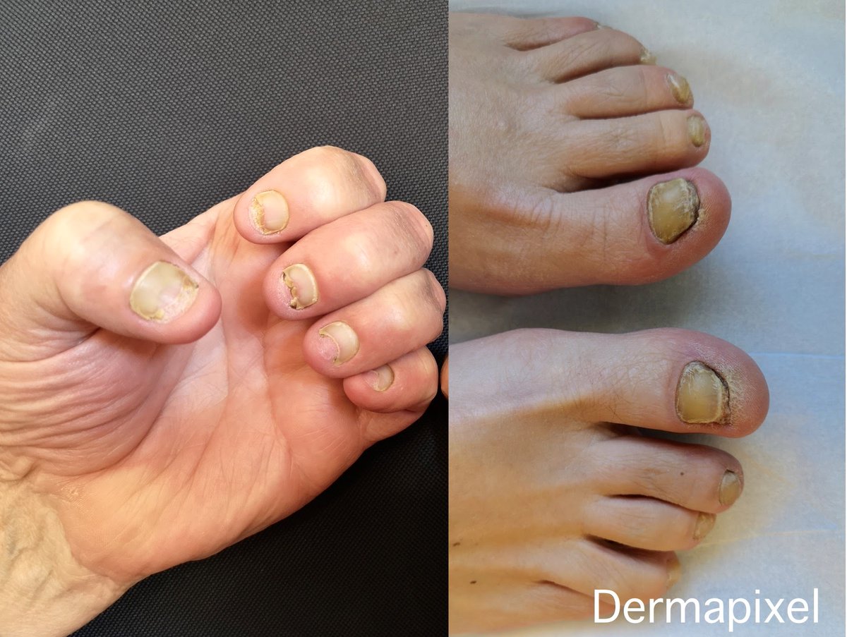 Esta semana en <a href="/dermapixel/">Dermapixel</a> hablamos del síndrome de las uñas amarillas, con un caso de <a href="/JuanJCauhe/">Juan Jiménez Cauhé</a> 
#dermatología 
dermapixel.com/2021/06/sindro…