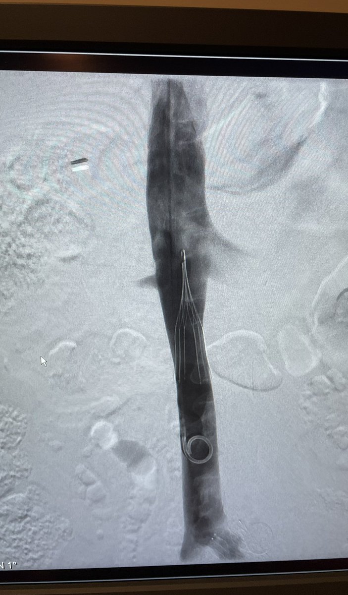Mike_Roark's tweet photo. Filter was placed back in March over a wire. Centered very well for the retrieval we did today! OptionElite and the new Retrieval Kit are a fantastic combo. @ArgonMedical #medtwitter https://t.co/D1UgtFTUnB
