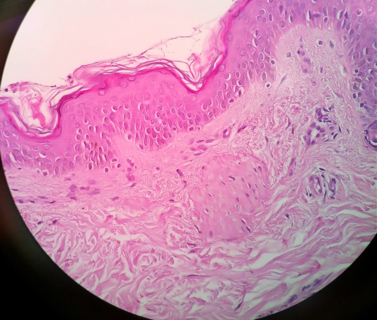 nadpath's tweet photo. Beautiful Meissner's corpuscle
#dermpath #PathTwitter https://t.co/OaS78zbJdS