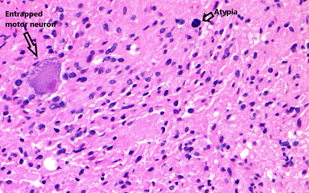 bitar_mireille's tweet photo. A rare #spinalcord lesion to occur in an adult patient. What molecular alteration to look for in this IDHwt #glioma? survival rate? Notice the infiltration, high cellularity, atypia, necrosis #neuropath #PathTwitter #Neurosurgery #molecularpathology #webpath #MedEd 
@NU_Pathology https://t.co/VswFfoFilT
