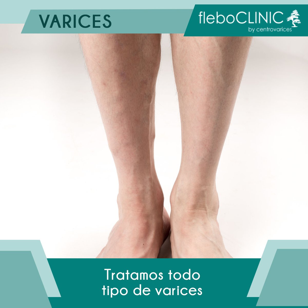 clinicflebo's tweet photo. ¡Tratamos todo tipo de varices: Arañitas, Úlceras Vasculares, Edemas, Trombosis, Culebrillas, Cototos y más! ¡Llámanos! https://t.co/MbXX09qCw4 https://t.co/Ohp7LhGFZ6