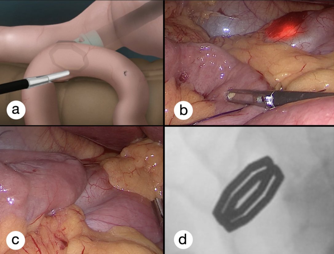 Rudolf Buxhoeveden (@rudolfbux) on Twitter photo Sutureless Duodeno-Ileal Anastomosis with Self-Assembling Magnets: Safety and Feasibility of a Novel Metabolic Procedure.
DOI: 10.1007/s11695-021-05554-z
<a href="/WindowsGi/">GI Windows Surgical</a> Sutureless Duodeno-Ileal Anastomosis with Self-Assembling Magnets: Safety and Feasibility of a Novel Metabolic Procedure.
DOI: 10.1007/s11695-021-05554-z
<a href="/WindowsGi/">GI Windows Surgical</a>