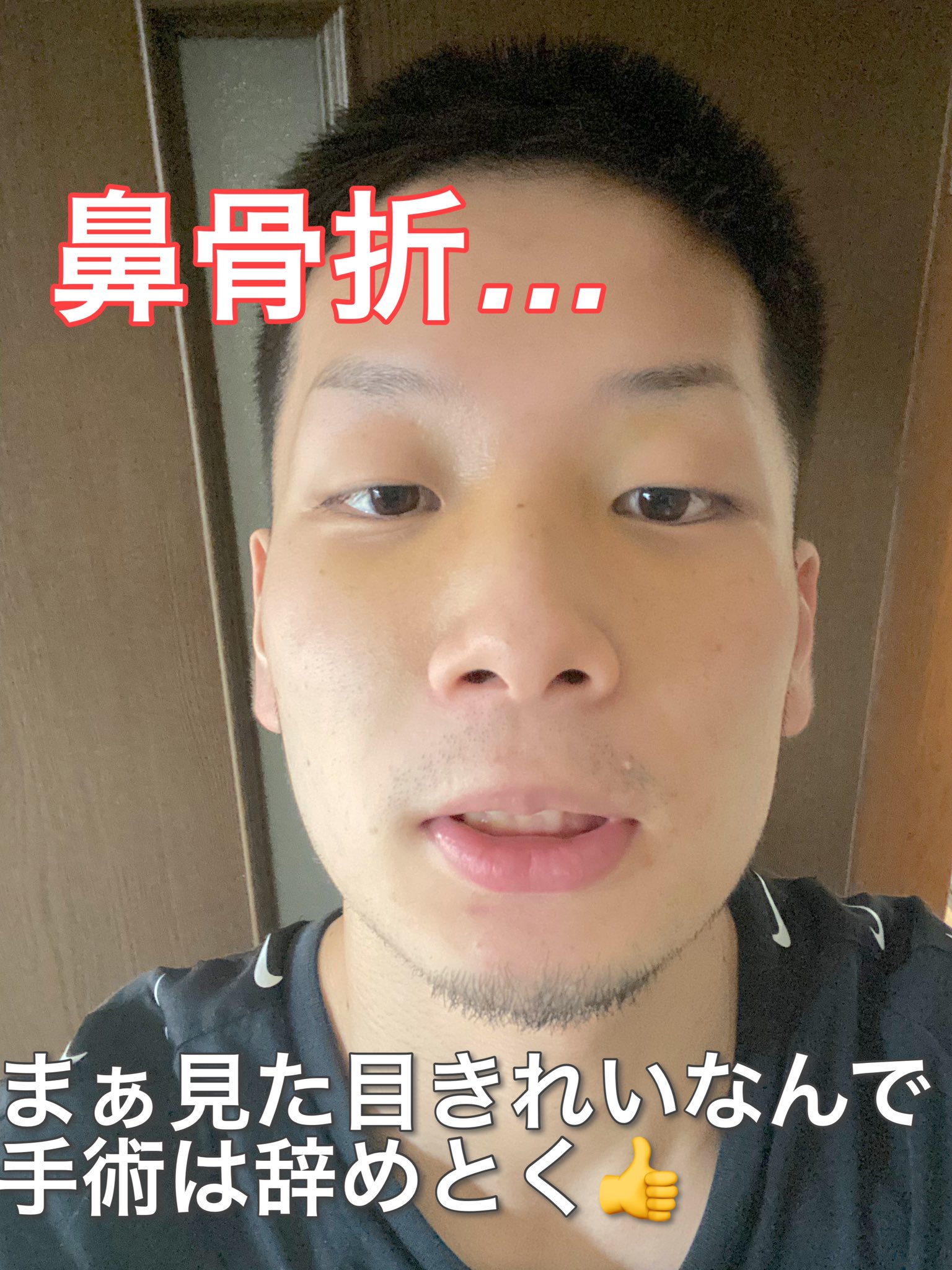 Ryo 対人恐怖症ボクサー 鼻の骨折に治療について 先ほど病院から帰って 減量中食べれなかった ケーキ を食べました笑 甘いもの最高 で 鼻の骨折についてなんですけど 会長からも 話を聞いて 見た目きれいですし 何の影響もでてないので 鼻は