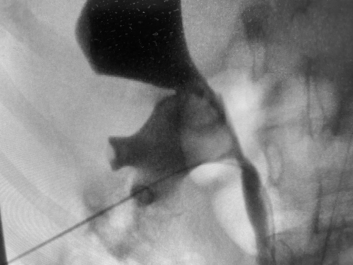 Percutaneous nephrolithotomy for a relatively easy stone in which we use the technique of <a href="/scoffonecesare/">scoffone cesare</a> generating space in the caliceal system using a little solution injected by the Chiba needle.
#PCNL
#nltp #urotips