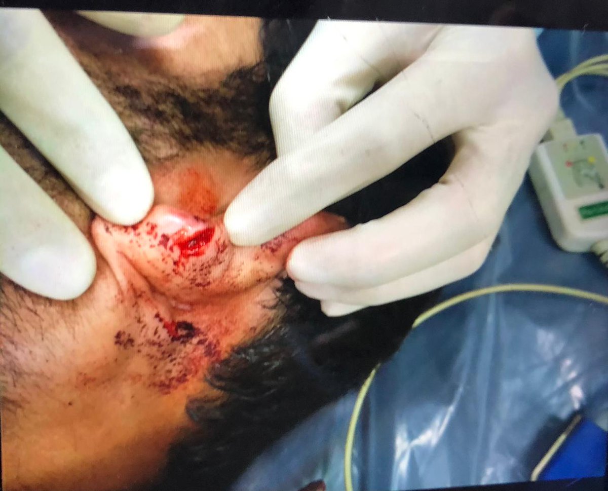 FAIMA_INDIA_'s tweet photo. Gift on DOCTORS DAY. 
Junior Resident Doctor of AIIMS beaten by goons and shopkeeper in Gautam Nagar at midnight saying that you doctors are spreading COVID 19! 
Shameful!
@FAIMA_INDIA_ Demands Strict Action Against Such Criminal offence. 
@DCPSEastDelhi @CPDelhi @DelhiPolice https://t.co/ss8Fgbk56T