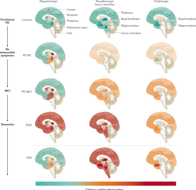 ScienceofPD's tweet photo. Required reading: #Parkinsons-associated cognitive impairment - a very useful primer from @AarslandDag &amp; colleagues
https://t.co/ZxiwpOuR3D https://t.co/hbaOidtaKN
