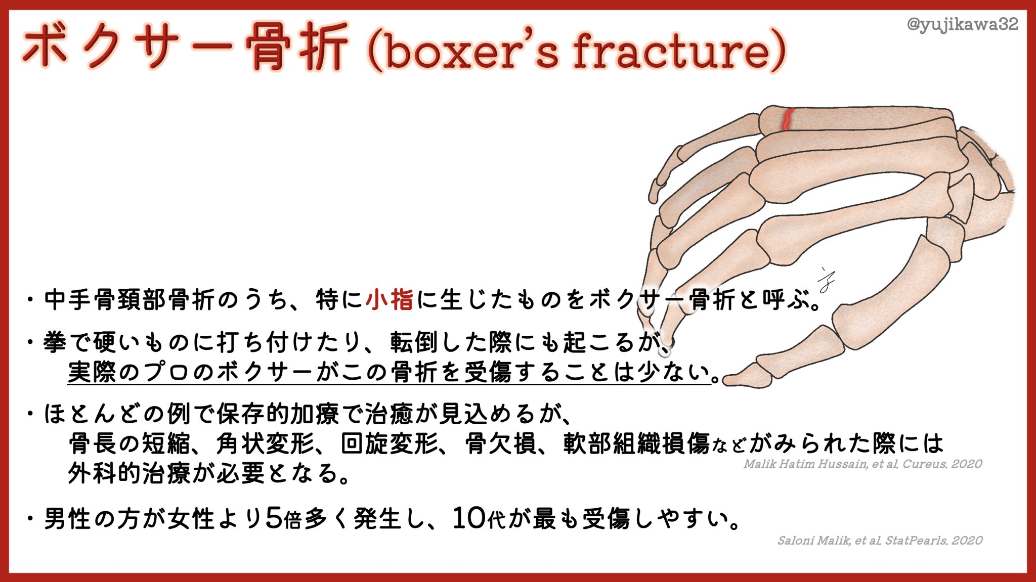 ユジカワ 整形dr イラストレーター 中手骨頚部骨折 ボクサー骨折とする本もあるが 実際にはどうなんだろうか 小指がボクサー 骨折 その他がファイター骨折と言っている先輩もいたが 海外論文では 小指中手骨頚部骨折 ボクサー骨折という表記は