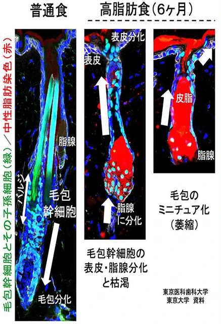 原因が判明！？薄毛の原因は脂っこい食事にあった！