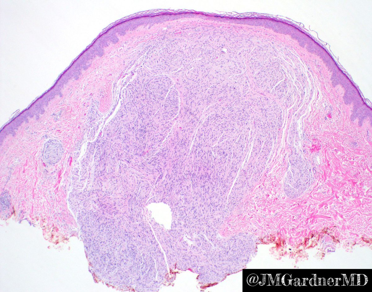 Jerad Gardner, MD on Twitter "Shave biopsy of pearly papule on