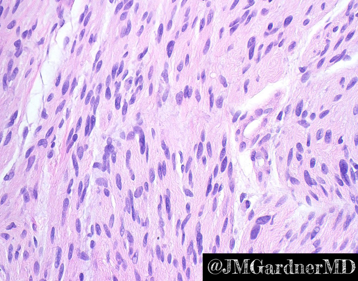 Jerad Gardner, MD on Twitter "Shave biopsy of pearly papule on