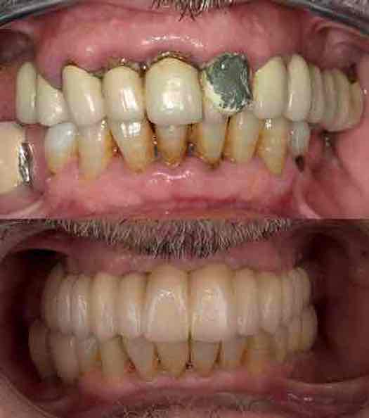 🗣 Qué tal si aprovechas ahora que la mascarilla no es obligatoria en exteriores para lucir tu mejor sonrisa?? 😬😬
#odontologia #sonrisa #smile #esteticadental #clinicabirbe #birbe #maxilofacial #carillasdentales #veneers #smiledesign #diseñosonrisas #carillas #laminats #dental