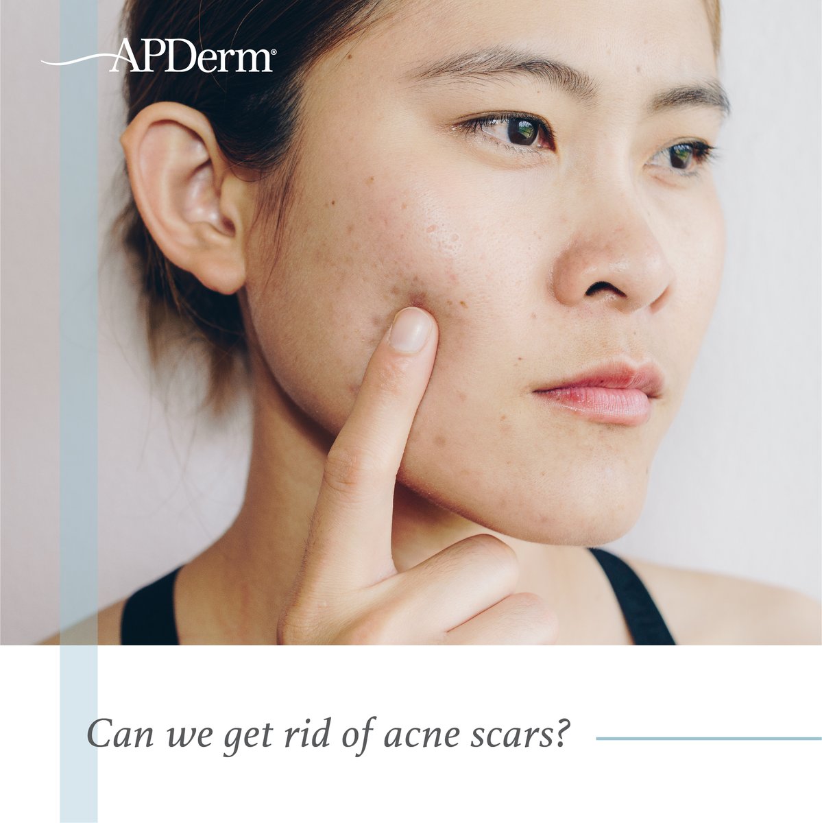 ap_derm's tweet image. After battling acne, many of us are still haunted by the ghosts of our blemished past. Is there anything that can lessen the appearance of acne scars? Check out our article below written by new dermatologist Kent Handfield.
bit.ly/3jt6A2q