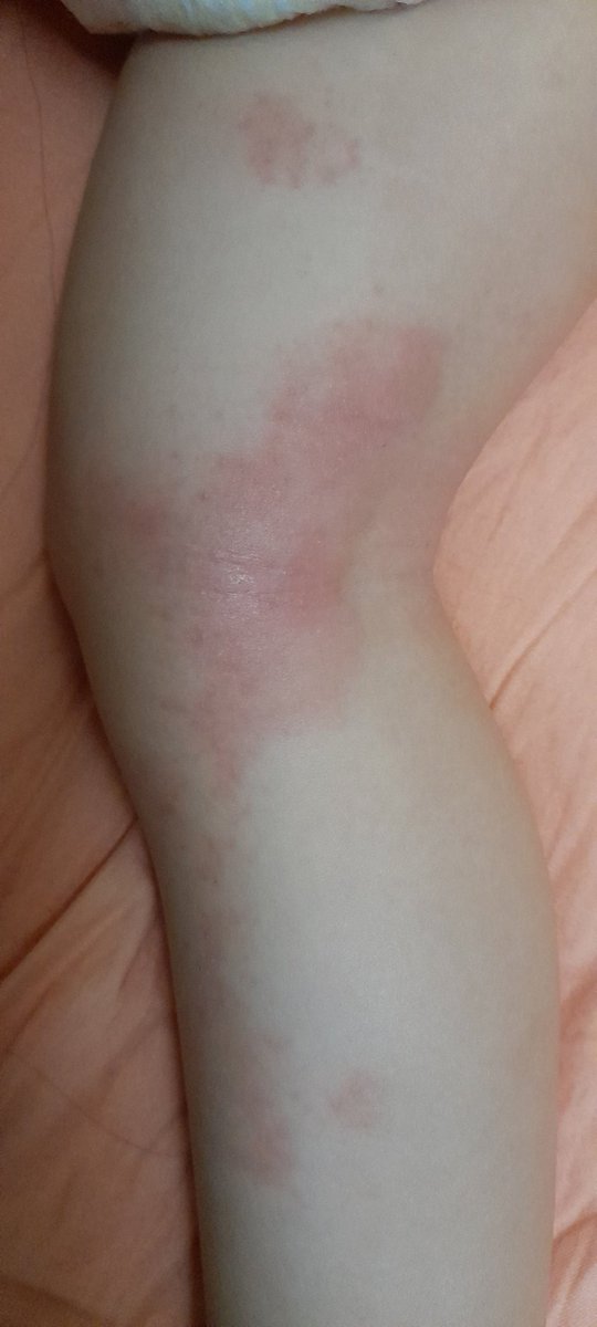 😭😭小少爺
真的好可憐喔
再不壓制得去小兒皮膚科
異位皮膚真的害死人ㄟ https://t.co/t3Qmr2uIlu