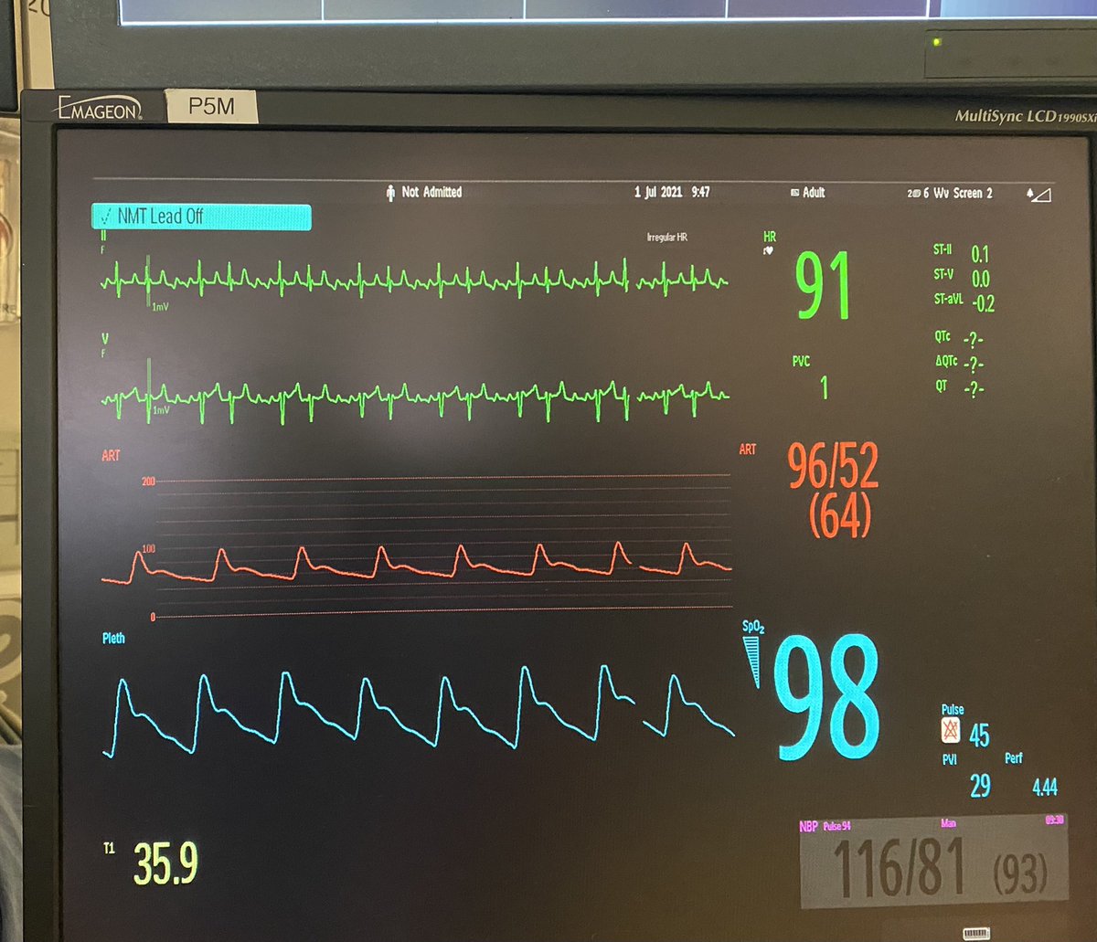 #EPeeps — another cool example of functional brady — this time in typical AFL.  Atrial rate ~280bpm, then 2 levels of AV block (2:1 followed by 3:2, appearing as a “typical” grouped-beating Wenckebach pattern), then pulse deficit on the “early” beats. Effective HR = 45!