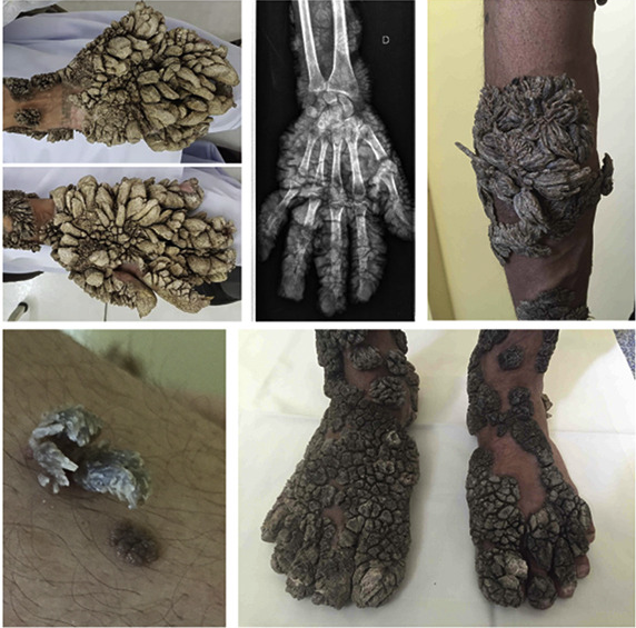 Casanova Lab On Twitter 2 One Of The 3 Patients Has Hpv2 Driven Giant Horns A Phenotype Often Referred To As The Tree Man Syndrome Https T Co 5yczeyzu0q Twitter