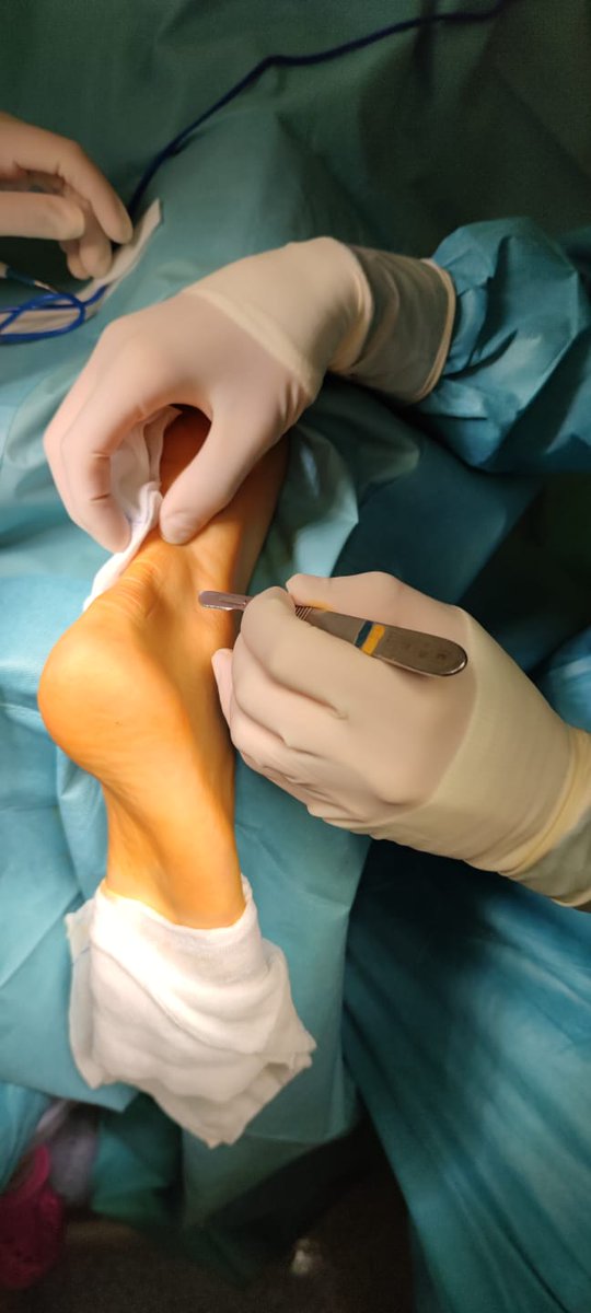 Capa1973's tweet image. Esto de la tendinopatía Aquiles y el síndrome de Haglund es una auténtica epidemia en el mundo del atletismo. Hoy le ha tocado a @VictoriaSauleda pasar por el quirófano, totalmente necesario y ya resuelto.
#tendinopatiaaquiea
#sindromedehaglund