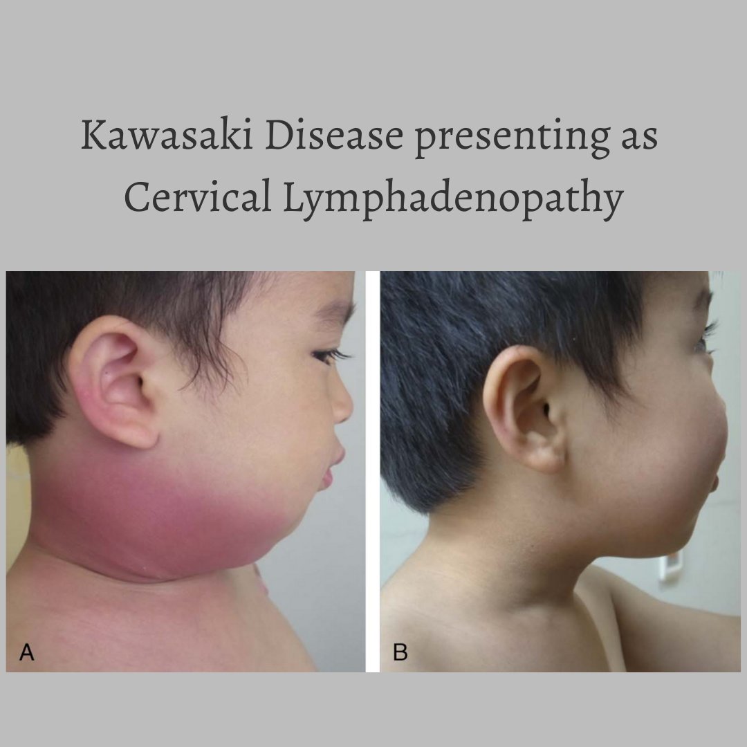 Cervical Lymphadenopathy informacionpublica.svet.gob.gt