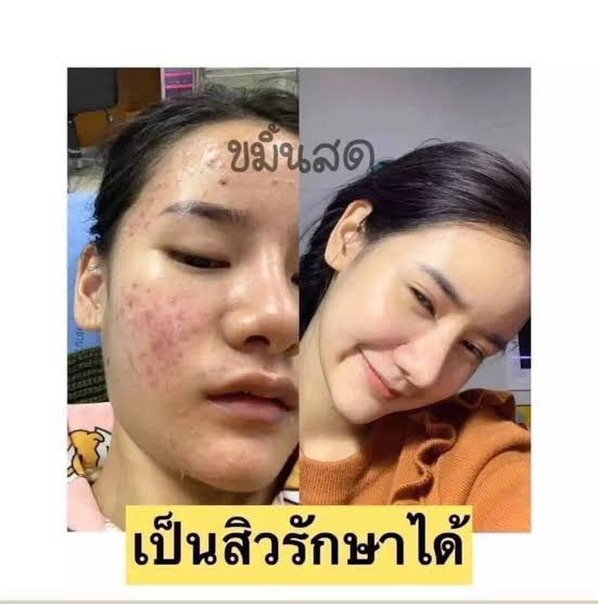 Nameskin1's tweet image. ครีมขมิ้นสด ช่วยเรื่องสิว รอยดำรอยแดง เค้าใช้เองสามารถทักมาปรึกษาได้เลยนะค่า❤️ ราคาเพียง230บาทรวมส่ง มีจำนวนจำกัด🌷#ครีมขมิ้นสด #สิว #ขมิ้นสด #อยากหน้าใส #ครีมหน้าใส #สิว #HowtoPerfect