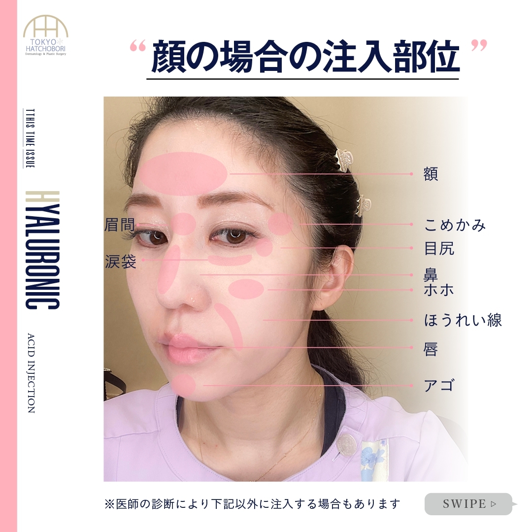 マナカナ先生 東京八丁堀皮膚科形成外科 ヒアルロン酸は打つ場所によって薬剤が異なります ボルベラ 小ジワや唇のボリュームアップ ボリフト ほうれい線 マリオネットライン 額の横 眉間の小ジワ ボリューマ 額の凹み アゴのボリュームアップ