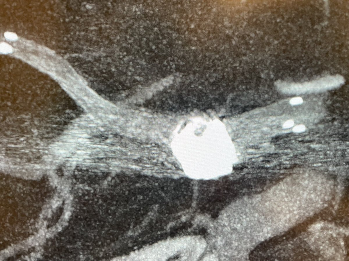Great results achieved with excellent pre-embo combined simulation of stent coiling! Atlas Stent and Axium coils together with <a href="/SimAndCure/">Sim&Cure</a> - did the job!