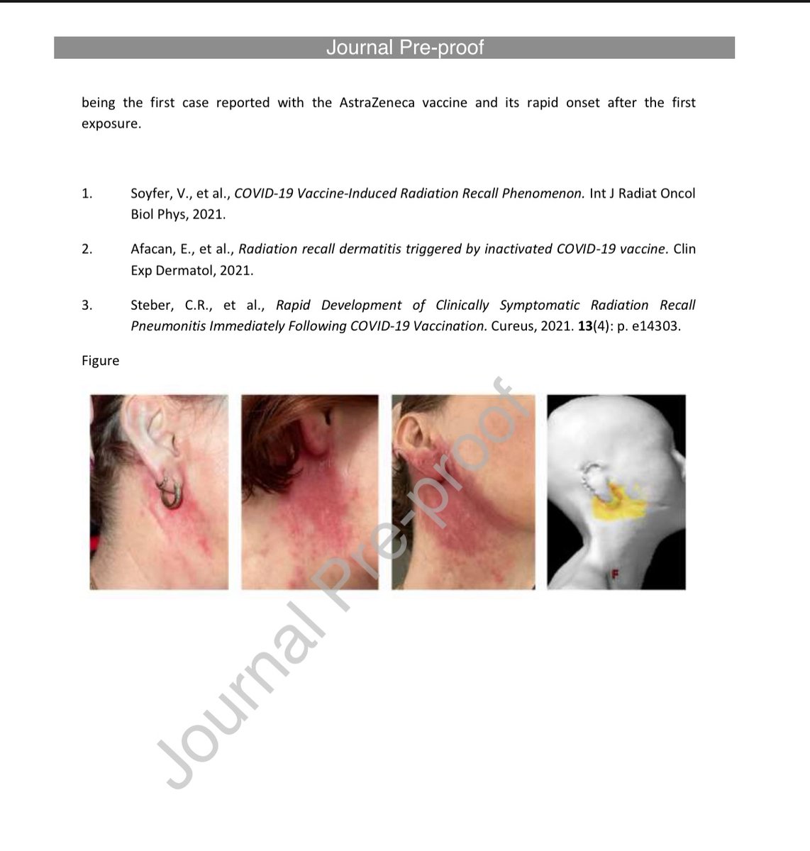 HoAssaf's tweet photo. #Radiation Recall phenomenon  after #COVID19 #vaccination 

#radonc watch out for this ? https://t.co/rQCDoG3Mz2