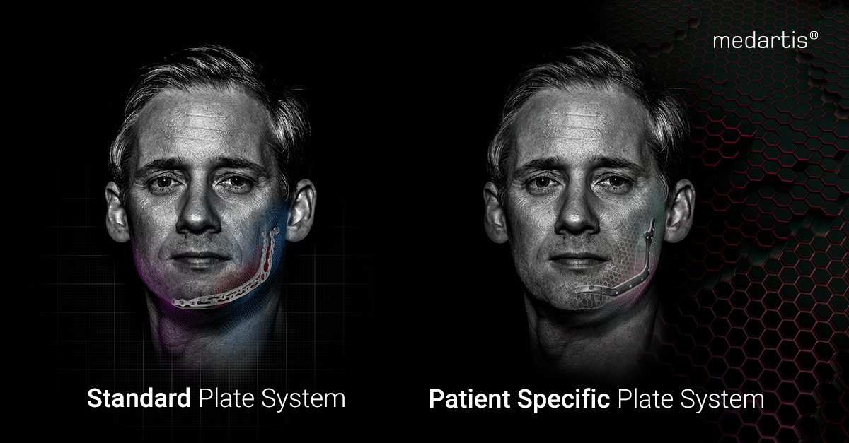 Medartis_Global's tweet image. 🗓️July 15,⏰11:30 – 12:25 CET
Experts Team: Prof. Schaller, Prof. Al-Nawas and Ralf Schumacher will discuss mandible reconstruction options - standard vs. patient specific plate system. Join our symposium @EACMFS_Congress. ​
#maxillofacialsurgery #orthognathicsurgery #MODUS2 #CMX