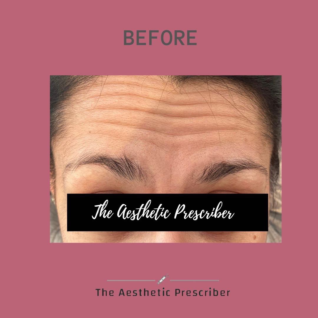 aestheticpresc's tweet photo. Anti-wrinkle injections are not just for older skin that suffer with fine lines and wrinkles?? 

PREVENTION IS BETTER THAN CURE!!!

Anti-wrinkle injections can be used as a preventative to stop fine lines from forming and becoming deeper. 

#SmoothLikeButter #aestheticprescriber https://t.co/QbUNVXKU5K