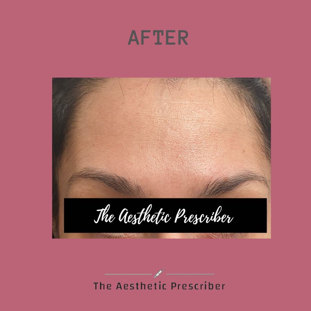 aestheticpresc's tweet photo. Anti-wrinkle injections are not just for older skin that suffer with fine lines and wrinkles?? 

PREVENTION IS BETTER THAN CURE!!!

Anti-wrinkle injections can be used as a preventative to stop fine lines from forming and becoming deeper. 

#SmoothLikeButter #aestheticprescriber https://t.co/QbUNVXKU5K