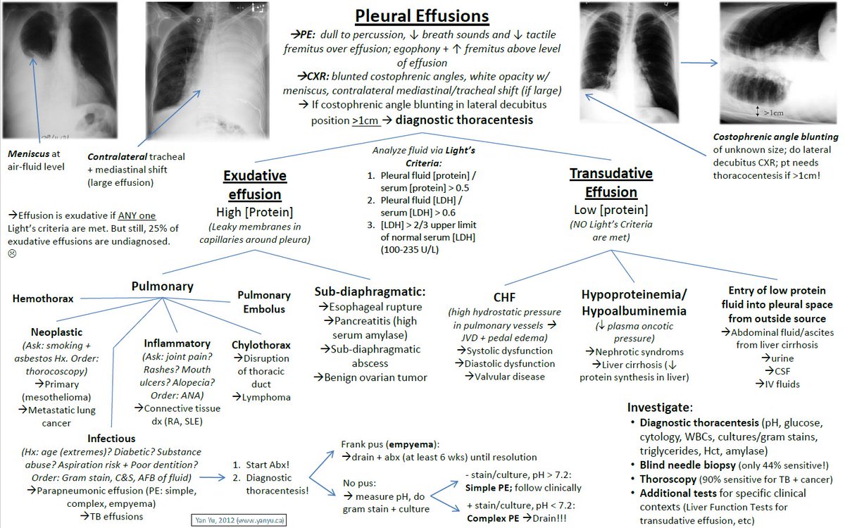 ManualOMedicine's tweet image. Approach to Pleural Effusions

#meded #foamed #medtwitter #usmle