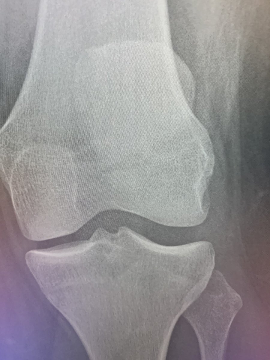 Acute trauma. No history of prior knee pain. Type one by bipartitepatella, about 5% of the patella cases.