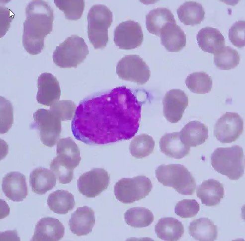 First #LJMFridayUnkowns of the new academic year bringing U a mantle cell lymphoma in spleen. Stains: CD5 &amp; cyclin D1.  This case was TP53-mut remember not all “leukemic, non-nodal” mantle cell lymphomas R indolent (despite what the name implies). Genetics 🧬 matter.. #hemepath