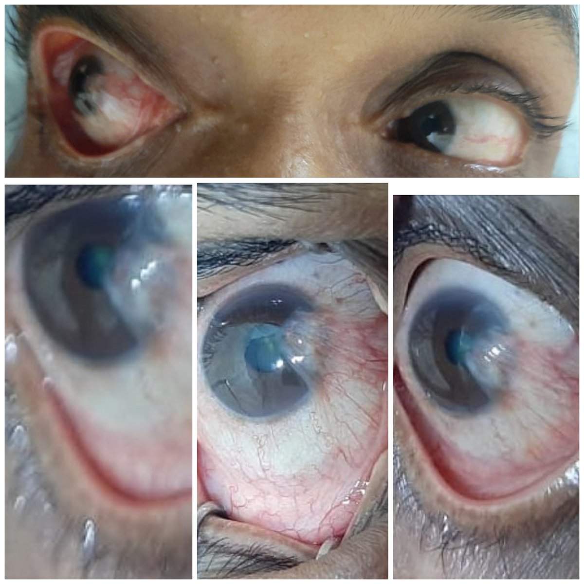 sumitaeyeclinic's tweet photo. #Mother of a #Nursing #Staff came to us saying that it looked #cosmetically bad. Was explained about #PTERYGIUM & advised removal
After #surgery she is happy & regrets for not coming early and getting it treated👀
#ophthalmology #eyetwitter #vision
👁eyecare because we care👁 https://t.co/skiUyOEfI3