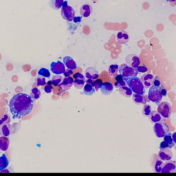 A patient in his 60s with unexplained fevers, arthritis and macrocytic anemia.
Extensive workup was done that was essentially negative (including normal copper levels). Bone marrow was done (aspirate images below). Further testing revealed UBA1 mutation.