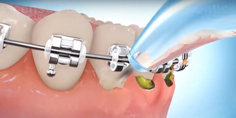 doktorgiginajib's tweet photo. 4 Kebaikan Water Floss 

"Flossing" bermaksud perbuatan membersihkan gigi terutamanya di celah gigi dan gusi dari sisa makanan dan plak.

Plak yang tidak dibersihkan dalam masa 24-48 jam boleh mengakibatkan penghasilan karang gigi atau tartar/calculus.

Karang gigi = masalah gusi https://t.co/FrMYop6rVM