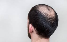 Techfuture111's tweet image. Alopecia
Sudden hair loss starts with one or more circular bald patches that may overlap.
Try Folisin bit.ly/3hvk2QC
#hairloss #hairlosssolution #hairlosstreatment #hairlosshelp #hairlossspecialist #hairlossclinic #hairlosssollution #hairlossprevention #hairlossproblems