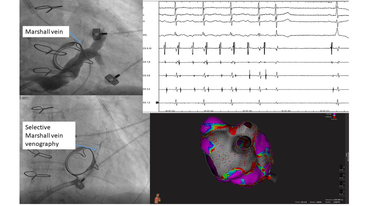 Left AFL redo in pt with mitral valve prosthesis. Based on ECG, we directly performed VOM alcolization. AFL interruption injecting just 1 cc of alcohol. Map with mitral isthmus block after VOM alcolization. @EPeeps @fbfteam @MiguelVldrbno @AiaClazio @stefbianchi @FilippoCauti