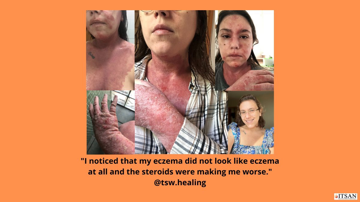 ITSANnonprofit's tweet photo. "This is not a perfect skin, but it’s a free skin. Free from steroids, free from my own judgment...I never thought I could be so strong but I was. I never thought I could survive this but I did. I wish healing for all of us. Celebrating 9 months steroid free."
@tsw.healing #itsan https://t.co/OVlCqLua80
