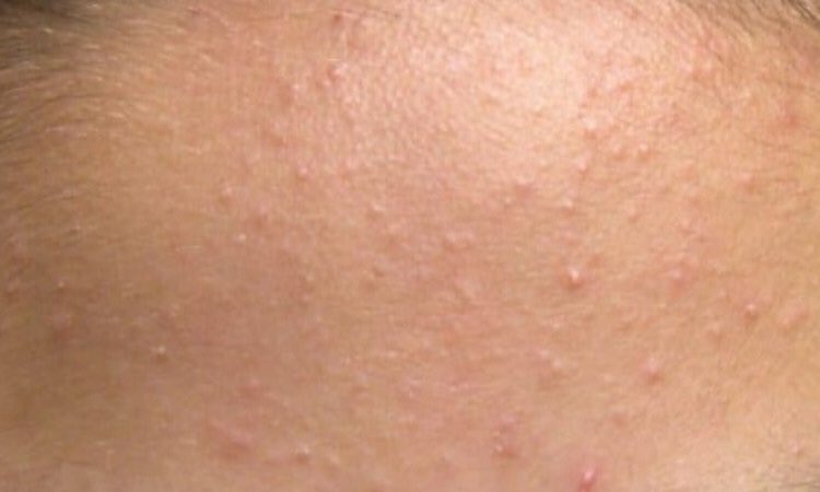 zaffy_co's tweet photo. 3 CARA HILANGKAN JERAWAT PASIR
.
1. Pakai cleanser AHA/BHA
- untuk membersihkan minyak berlebihan
2. Gunakan exfoliation toner/serum
- penetrate dalam kulit untuk mencuci pori
3. Pakai pelembab yang sesuai
- tekstur ringan, oil-free dan tidak menyumbat liang pori https://t.co/Q6NIOz825d