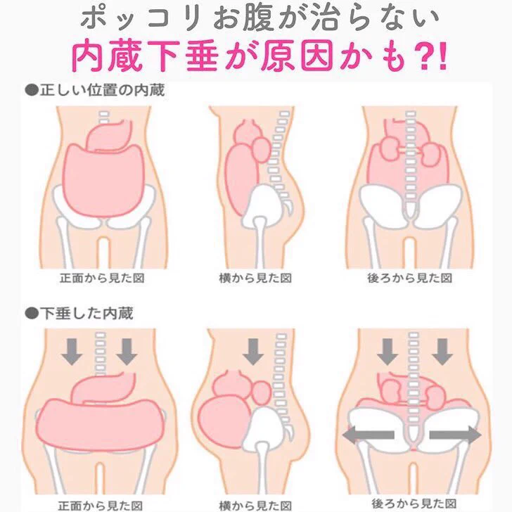 ポッコリおなかで悩んでいる方！必見。内臓下垂撃退
