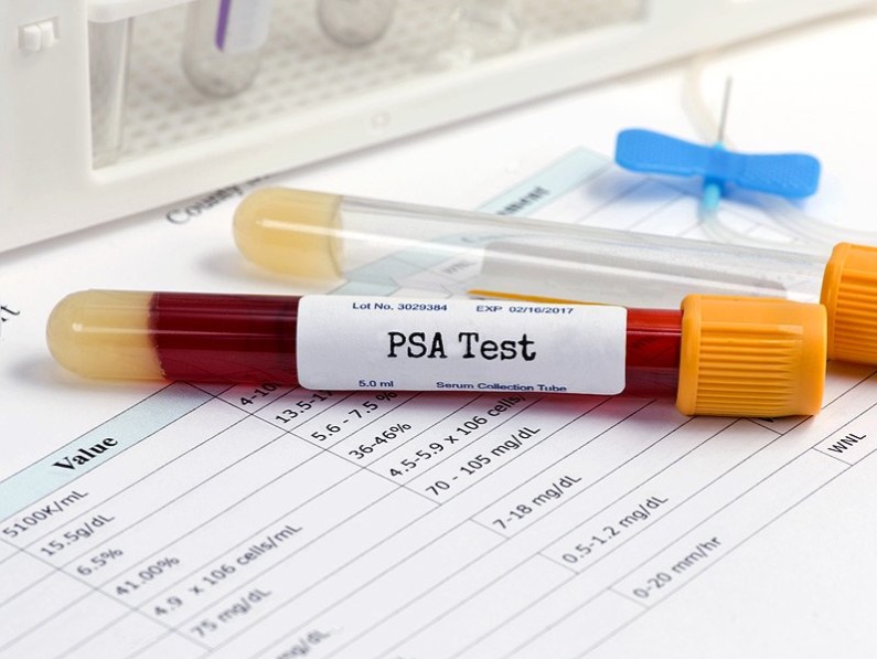 Increased PSA Screening Associated With Lower Risk of Advanced Prostate Cancer at Diagnosis, Mortality in Younger African American Patients bit.ly/2SFJquB