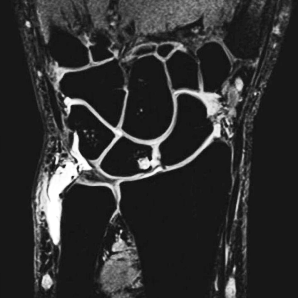 advanced_mri's tweet photo. 3D DESS
DESS use limited to High resolution cartilage imaging and muskeloskeletal
Fluid is very bright and Bone is relatively dark due to T2* dephasing from trabeculae.
Weight: T2/T1-weighted
#advanced_mri #medical #radiology #wrist
#orthopedics #mri #mrilogy #medical_imaging https://t.co/eHXLtdo1gh