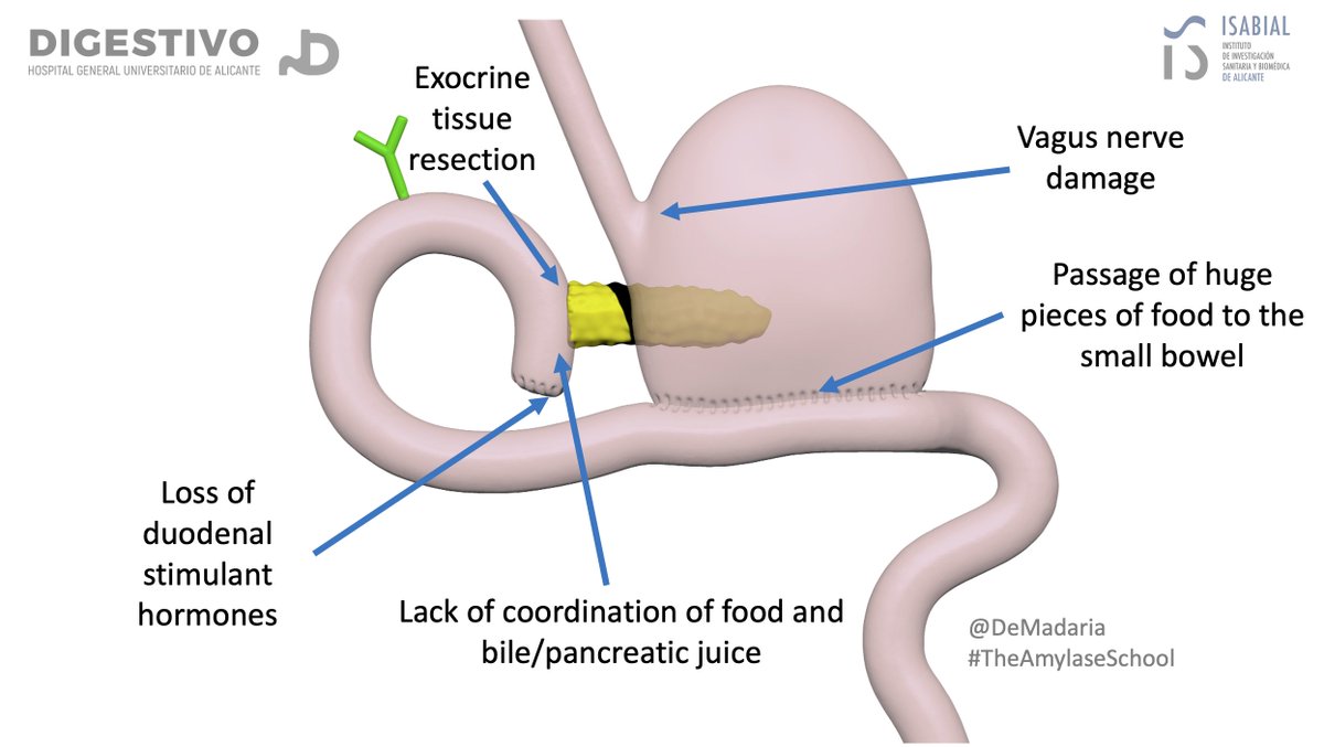 DeMadaria's tweet image. Pancreatic exocrine insufficiency after a Whipple procedure/ cephalic duodenopancreatectomy
#TheAmylaseSchool #DigitalModeling #MedArt #Medicalillustration
More info in this @AnnalsofSurgery Systematic Review from our group: journals.lww.com/annalsofsurger…