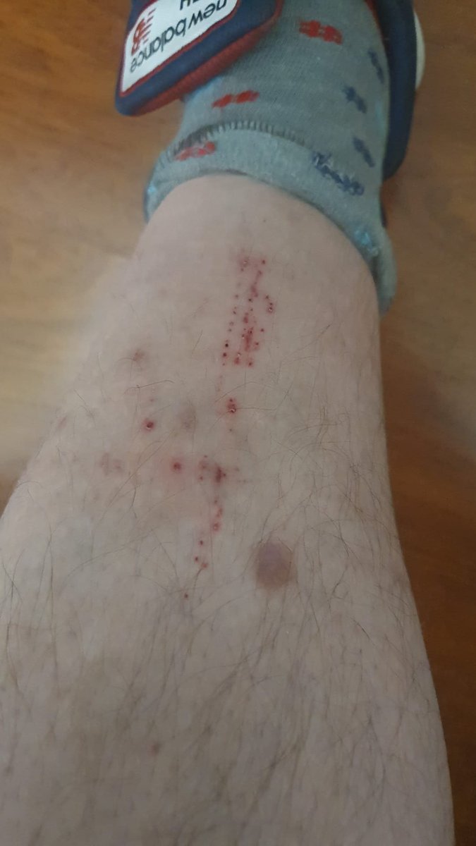 datmo0577's tweet photo. No se si sera "alergia" pero lycra o algodon me provocan esto https://t.co/F0LNKOosKO