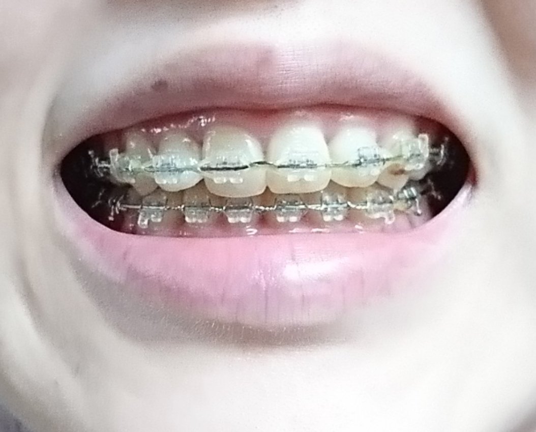 Ann 歯列矯正アカ Ann Twitter