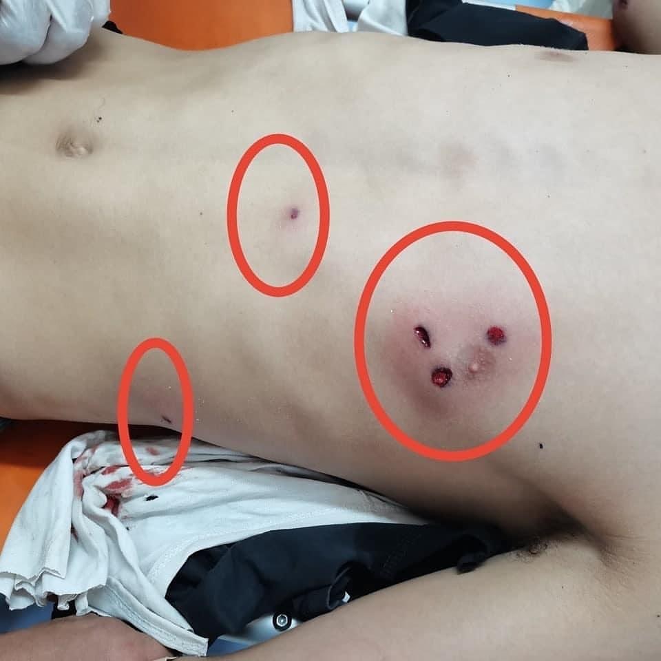 fakhrifadzli's tweet photo. Kecederaan yang dialami oleh seorang remaja di #Beita, Muhammad Hamayel akibat tembakan oleh Tentera Zionis. Luka yang dialami bukan luka biasa. 

Menurut laporan perubatan, Israel menggunakan expanding bullet yang diharamkan oleh undang² antarabangsa. #SaveBeita

Jenayah perang. https://t.co/IiAXmPuAVt