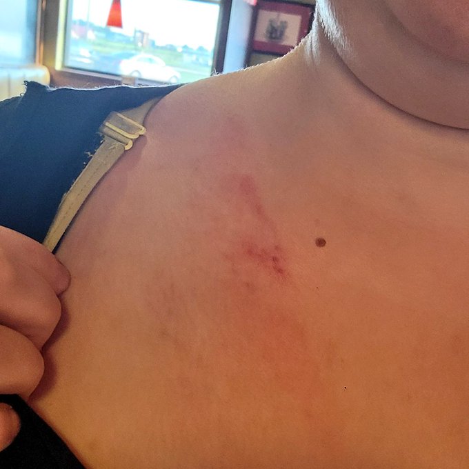 Not the bruising I wanted this weekend 😔. Seatbealts save lives though. Wear yours, please. I'm ok. I'm<a href="/tag/tittytuesday"class="tags"><span>#tittytuesday</span></a>