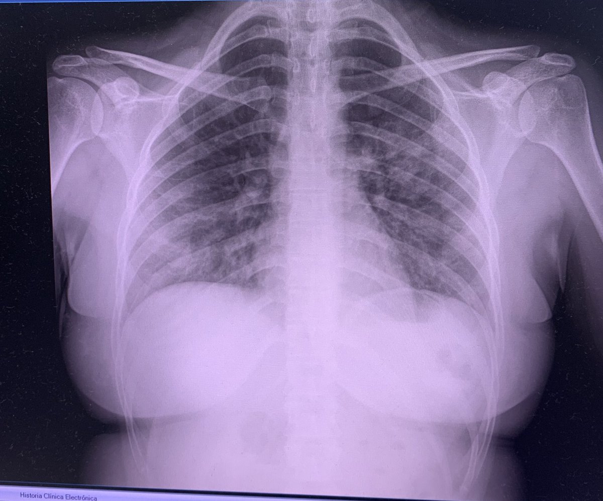 Asier Bengoechea (@asierbengoca) on Twitter photo Paciente de 28 años sin antecedentes de interés con insuficiencia respiratoria. Los jóvenes no son inmunes al #COVID19. Esto no ha acabado... <a href="/SEMES_/">SEMES</a> <a href="/SeparRespira/">SeparRespira</a> <a href="/ccarballo50/">Cesar Carballo</a> <a href="/juliomayol/">Julio Mayol</a> <a href="/jtorresmacho/">Juan Torres Macho</a> Paciente de 28 años sin antecedentes de interés con insuficiencia respiratoria. Los jóvenes no son inmunes al #COVID19. Esto no ha acabado... <a href="/SEMES_/">SEMES</a> <a href="/SeparRespira/">SeparRespira</a> <a href="/ccarballo50/">Cesar Carballo</a> <a href="/juliomayol/">Julio Mayol</a> <a href="/jtorresmacho/">Juan Torres Macho</a>