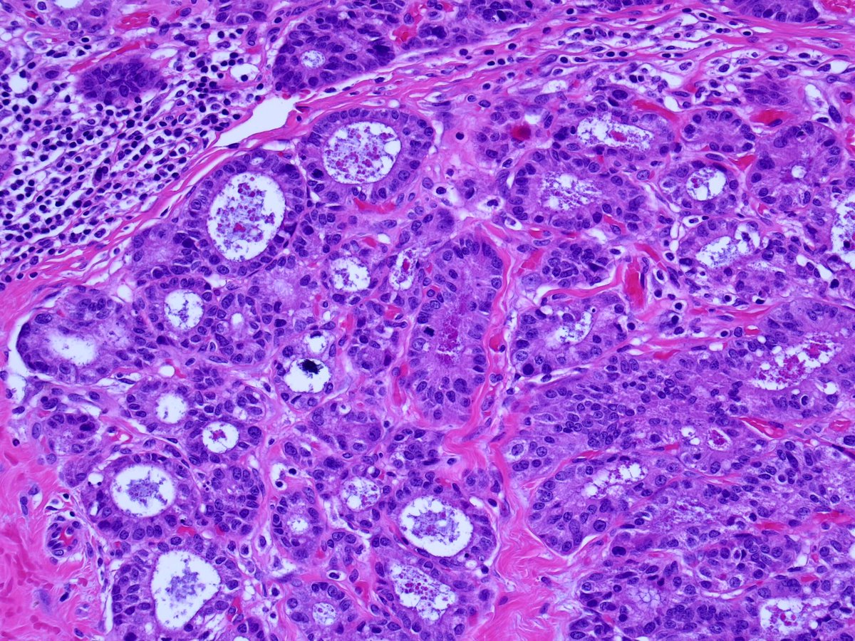 #Breastpath #Surgpath #Pathresidents 

63 Year old female; excisional biopsy of an 8mm breast mass.